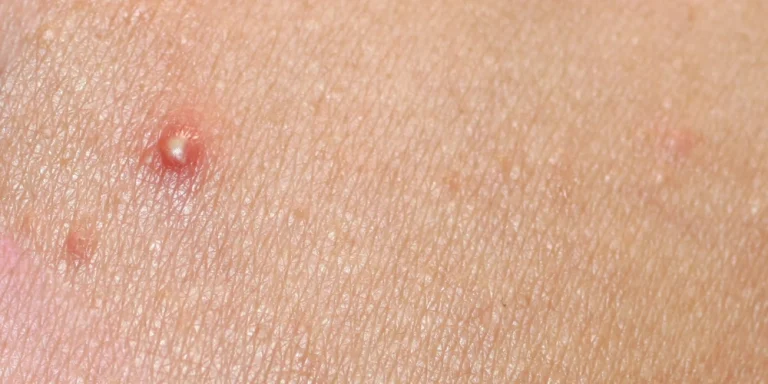 How can I reduce face puffiness naturally?