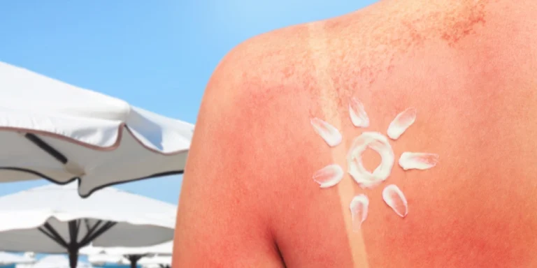 What are the natural ways to protect skin from sun damage?